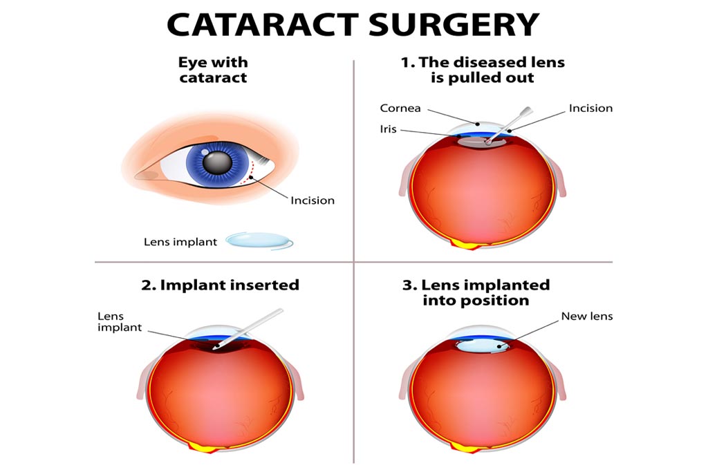 Cataract Surgery